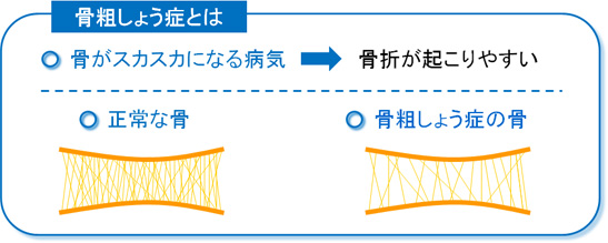 骨粗しょう症の説明図